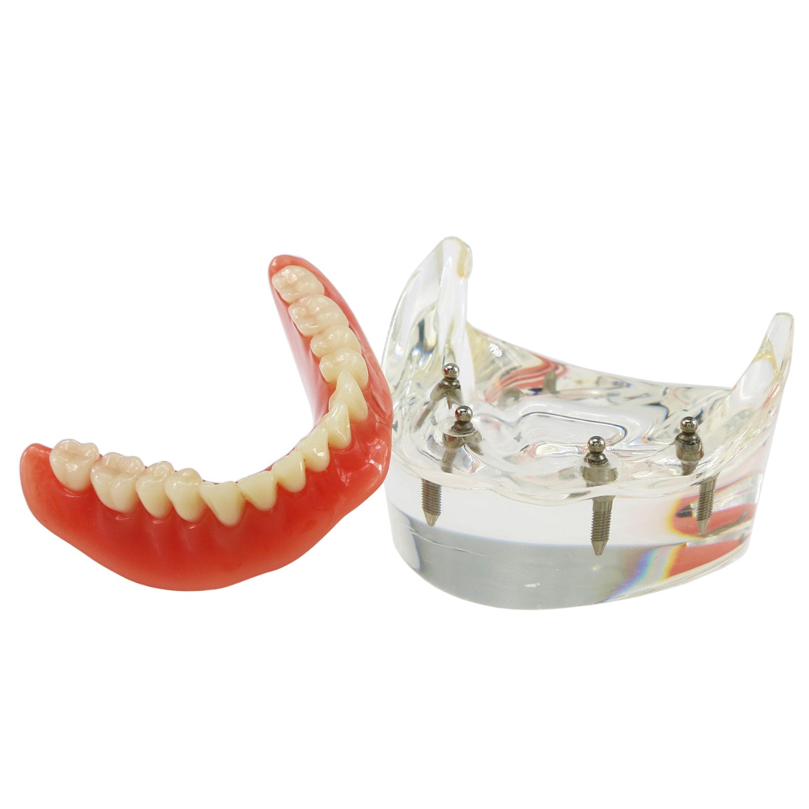Dental Teeth Model 2 4 Implant Overdenture Typodont Restoration Demo Upper Lower