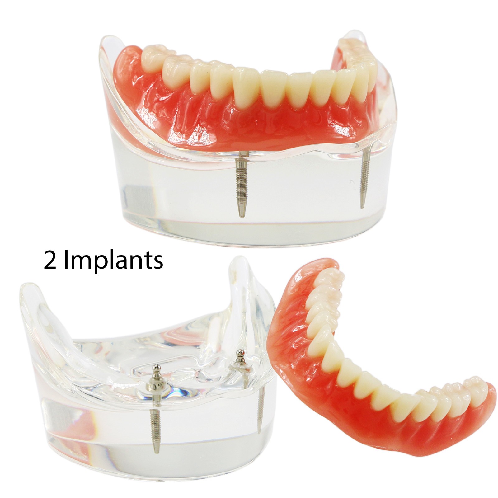 Dental Teeth Model 2 4 Implant Overdenture Typodont Restoration Demo Upper Lower