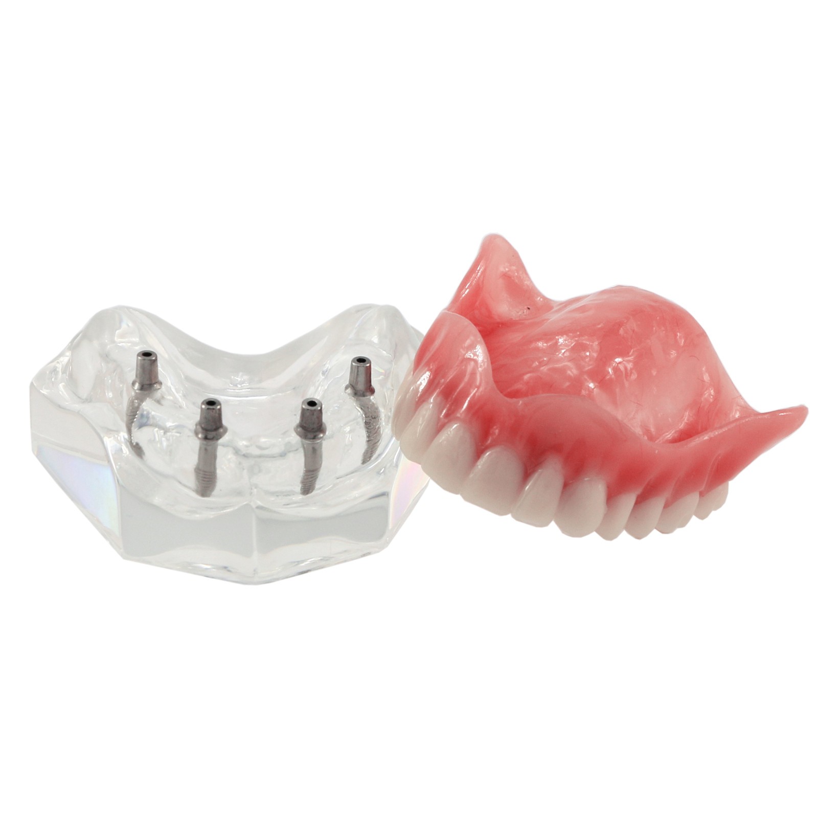 Dental Teeth Model 2 4 Implant Overdenture Typodont Restoration Demo Upper Lower