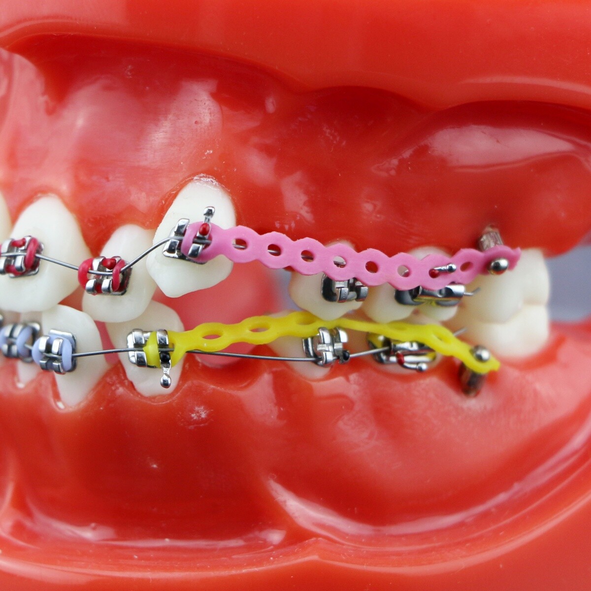 Dental Typodont Teeth Model Orthodontic Treatment Metal Ceramic BracketsRetainer