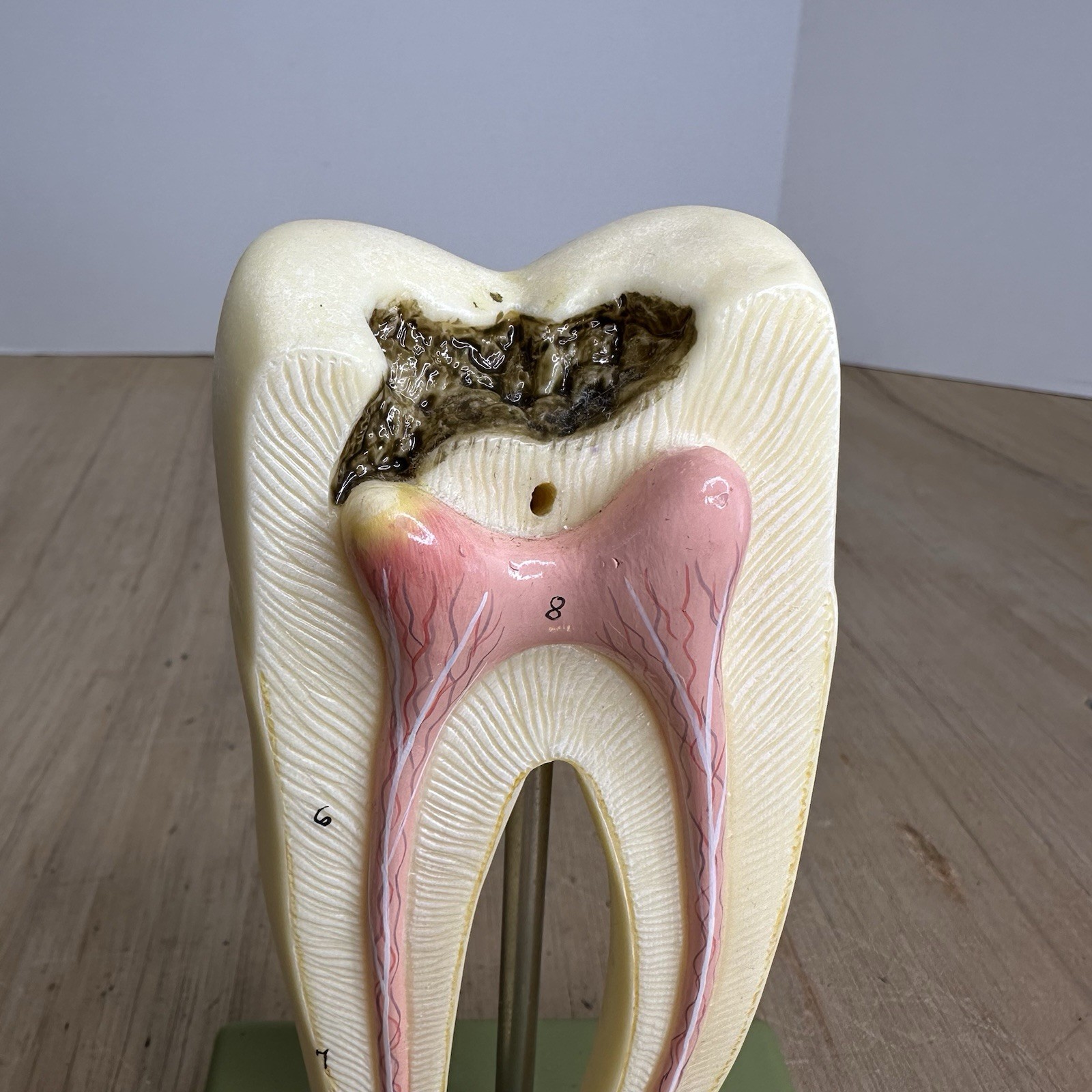 VTG SOSMO TOOTH ANATOMICAL MODEL DISPLAY DENTAL DENTISTRY EDUCTATIONAL GERMANY
