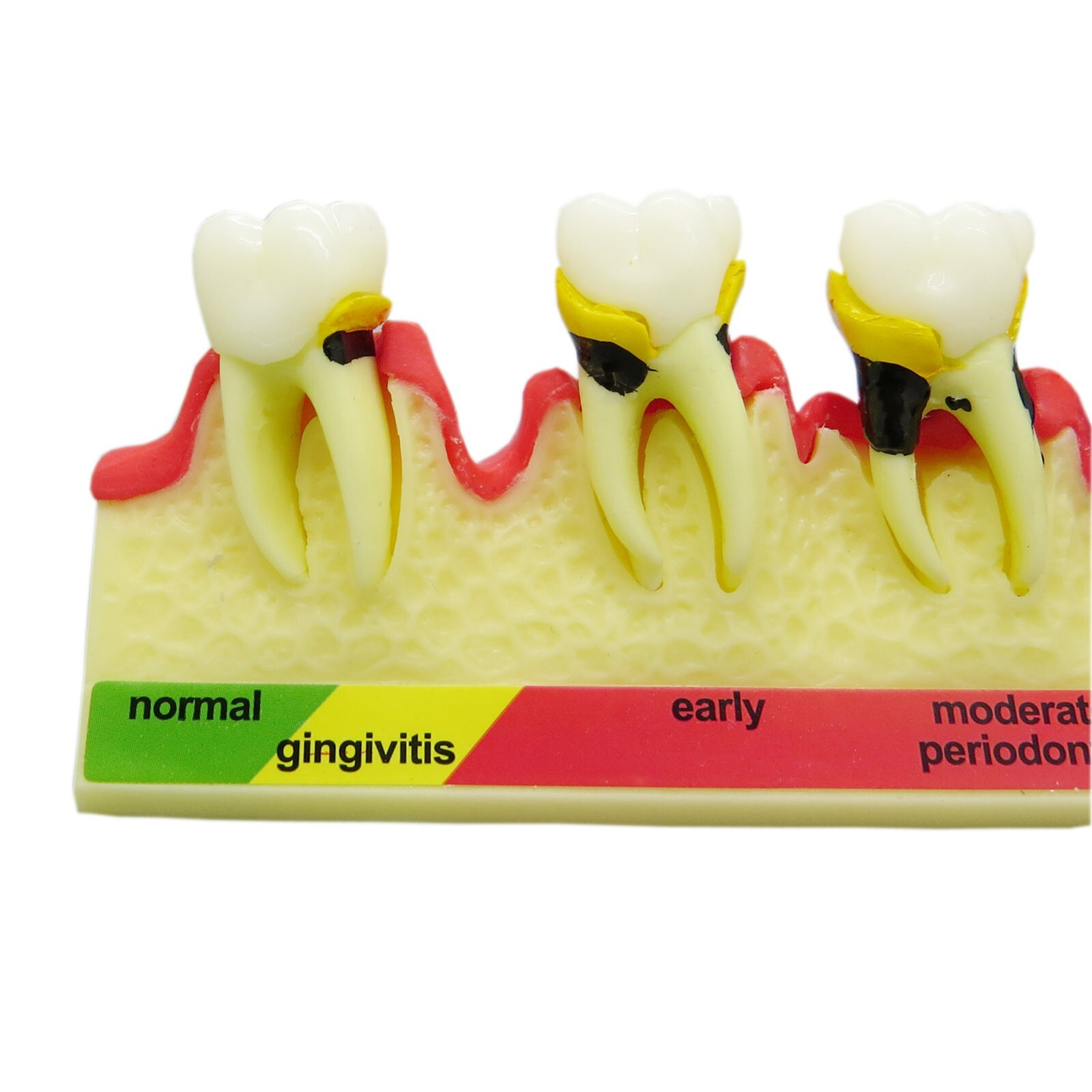 Dental Periodontics Disease 5-Stage Teeth Model Perio Disease Assort Demo Model