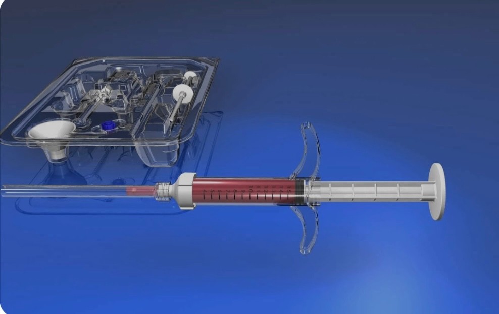 Nordson Medical Osteoprecision Disposable Graft Cannula, Sterile Packed, 150 mm