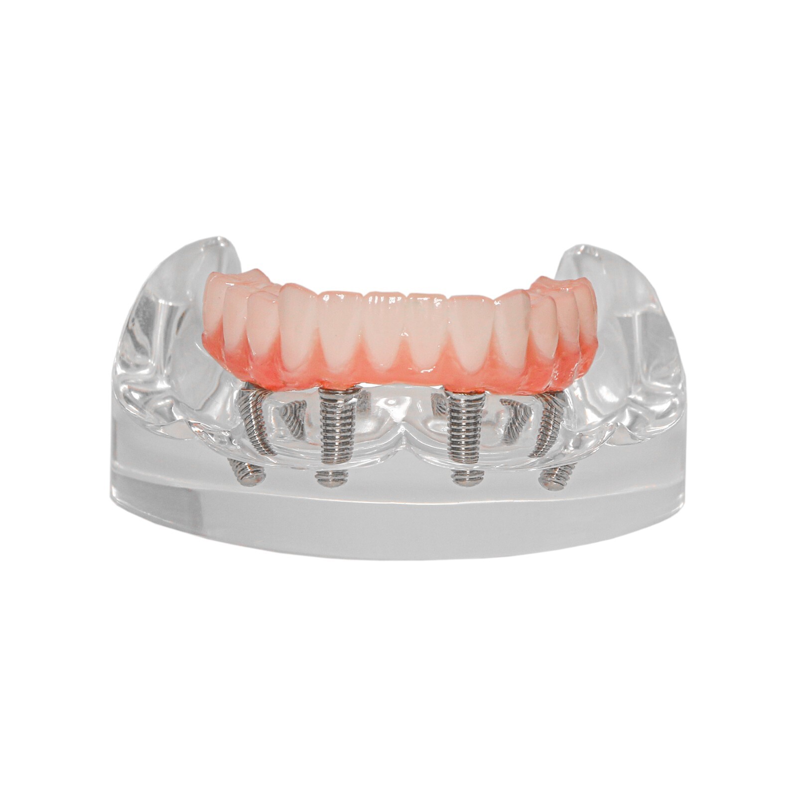Dental Implant Overdenture Model Upper Lower Jaw Teeth Model with 2/4/6 Screws