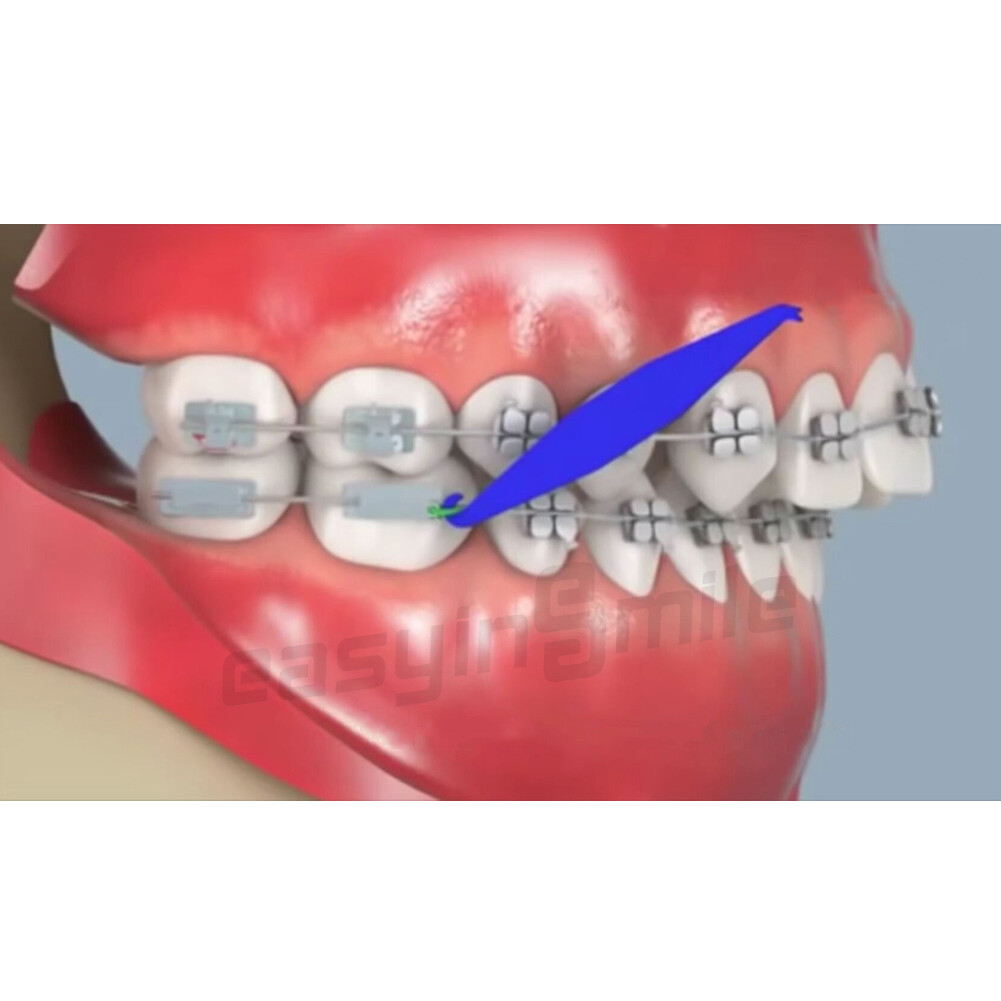 100Pcs Dental Orthodontic Placers 6cm Elastic Rubber Band Mix Color For Braces