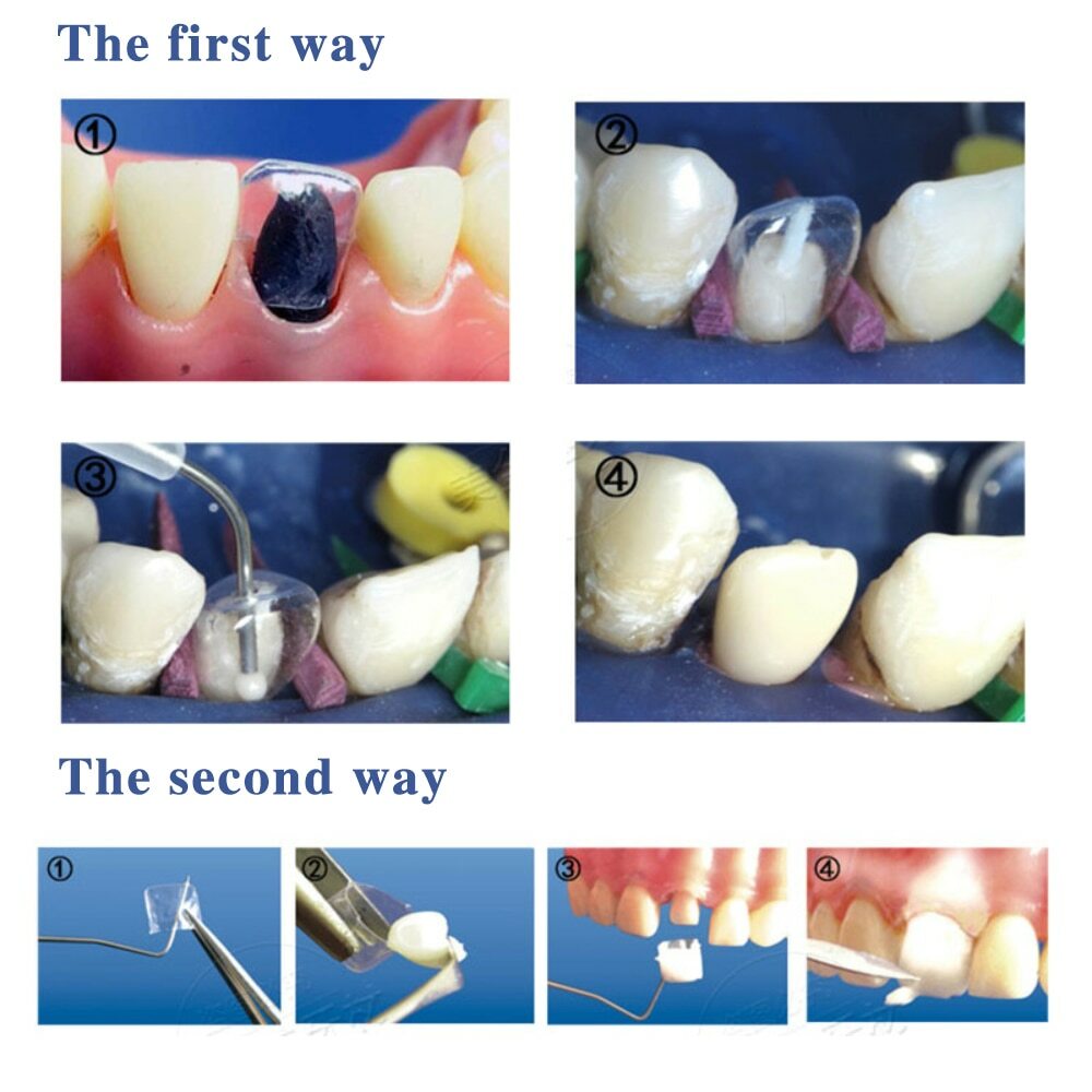 Anterior Transparent Crowns Dental Temporary Crown Adult Braces Pre-crowned