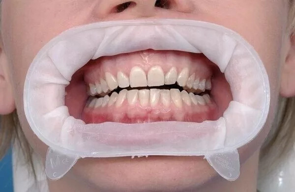 Ivoclar Optragate Dental O Shape 3D Mouth Opener Lip Cheek Retractor Latex Adult