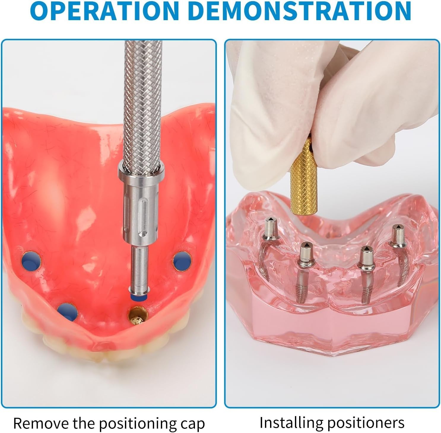 US Dental Fit Zest Anchors Locator Retention Caps Range & Core Tool Overdenture