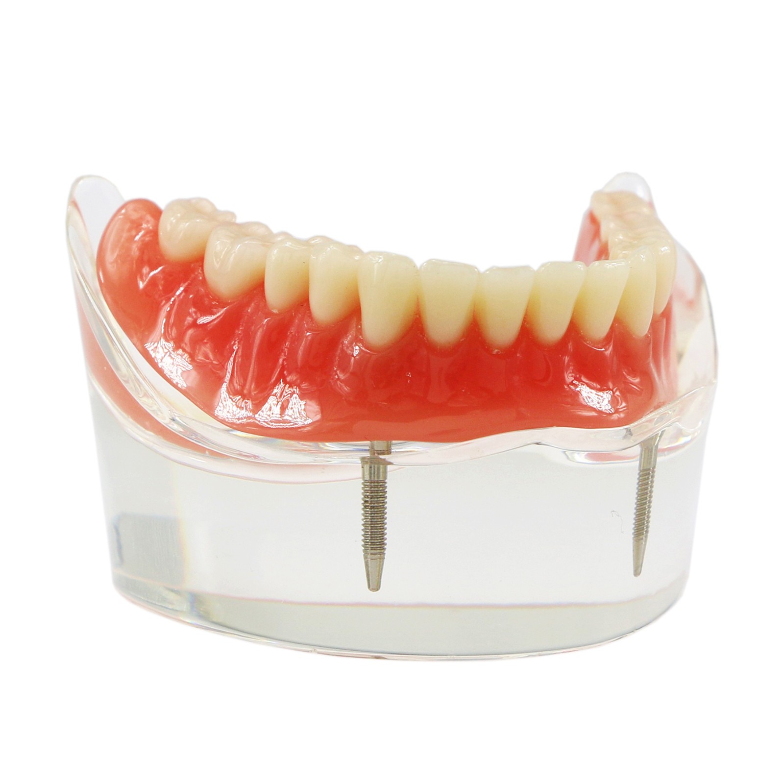 Dental Teeth Model 2 4 Implant Overdenture Typodont Restoration Demo Upper Lower