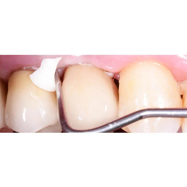 GC Gold Label 1 Luting & Lining GIC Luting & Lining glass ionomer Cement