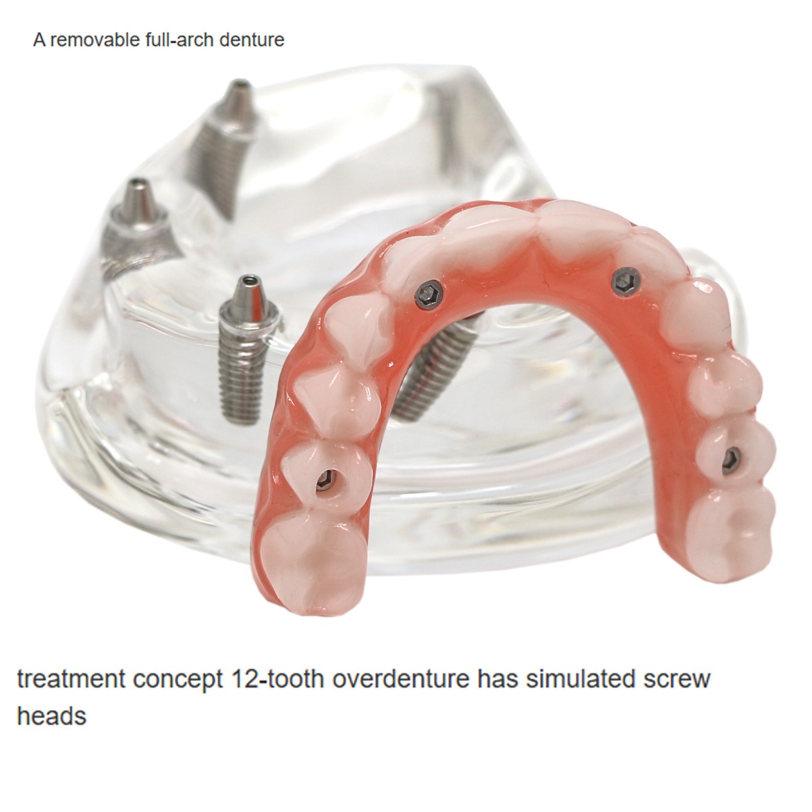 Clear Base Detachable All-on-4 /All-on-6 Overdenture Dental Implant Study Model