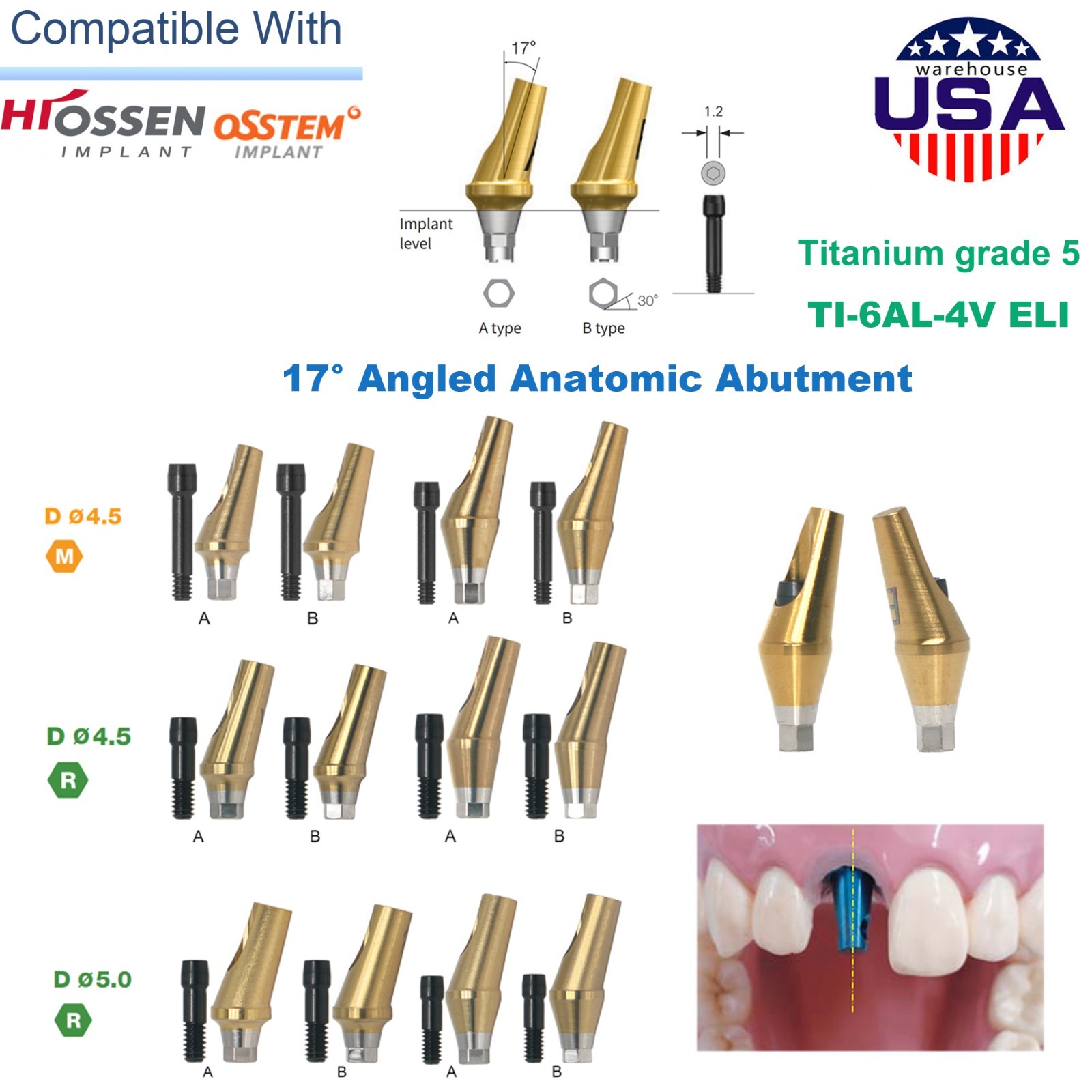 US 5Pcs 17° Angled Anatomic Abutment Hiossen Osstem Mini Regular Hex Titanium