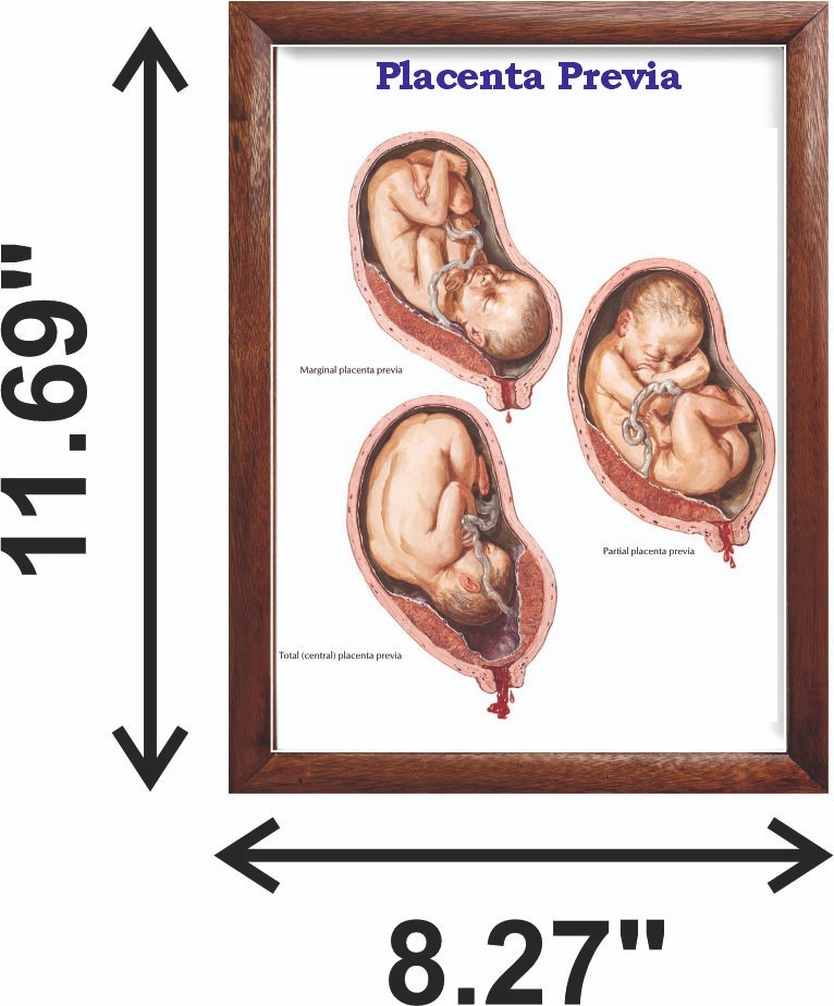 Placenta Previa Chart 12×18 inches