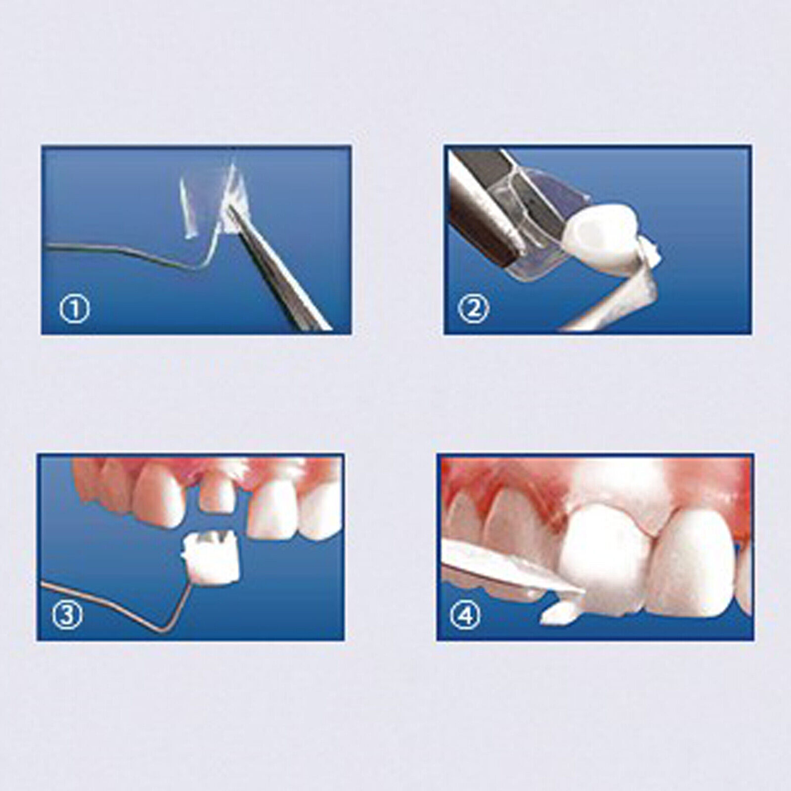 Dental Anterior Transparent Forms For Temporary Crowns 1.910 Kit TOR VM 64Pcs