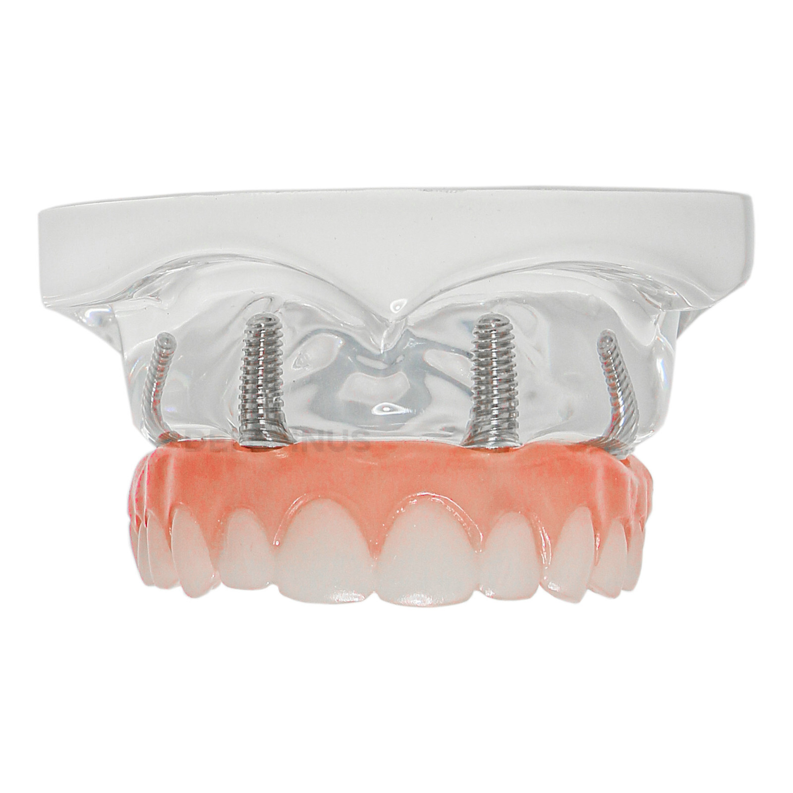 Dental 4 Implants Demo Implant Teeth Model Restoration Overdenture Upper/Lower