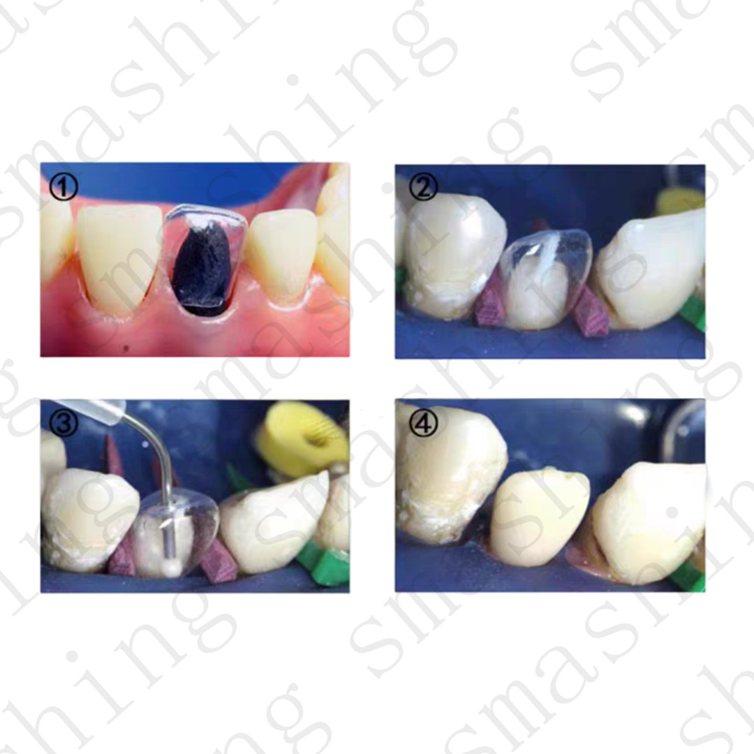 64Pcs Dental Anterior Transparent Forms For Temporary Crowns 1.910 Kit TOR VM