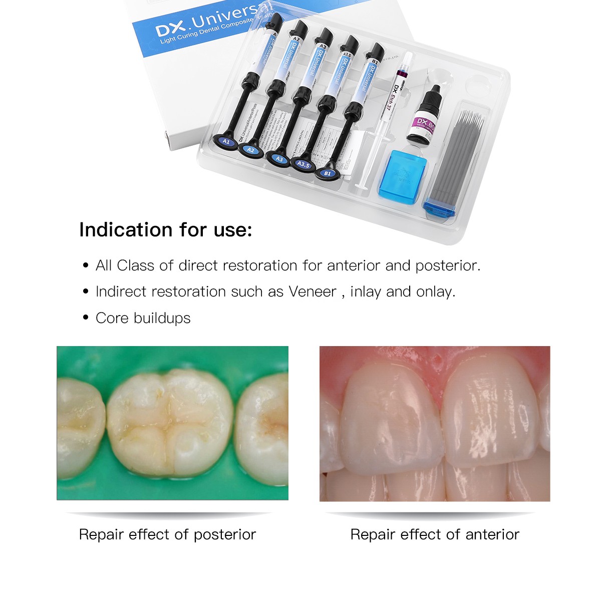 Dental Light Cure Composite Kit 5 Colors A1-A3.5 with Etchant & Bonding Agent