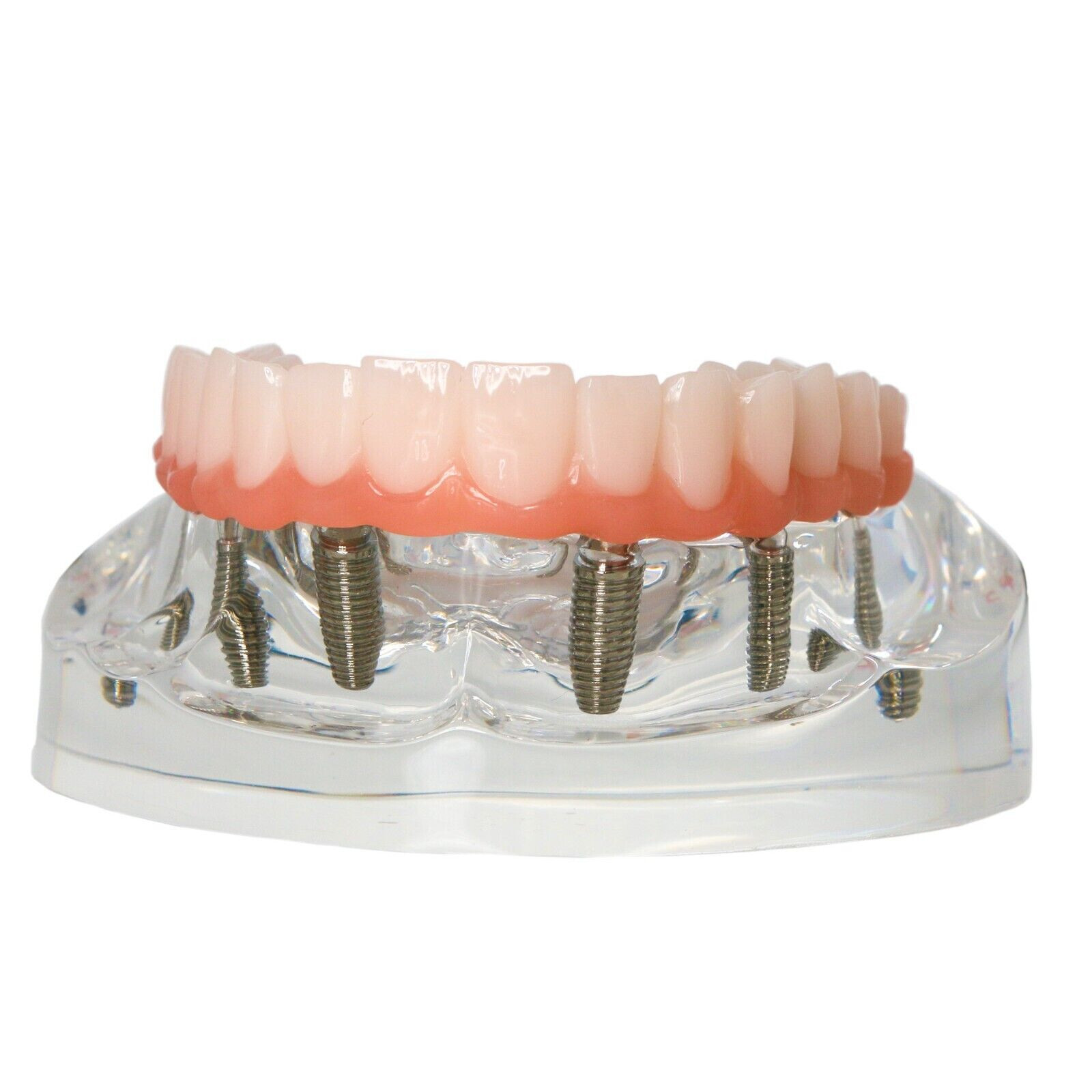US Dental Implant Restoration Model Upper Jaw 6 Screws Post Core Bridge M6001-2