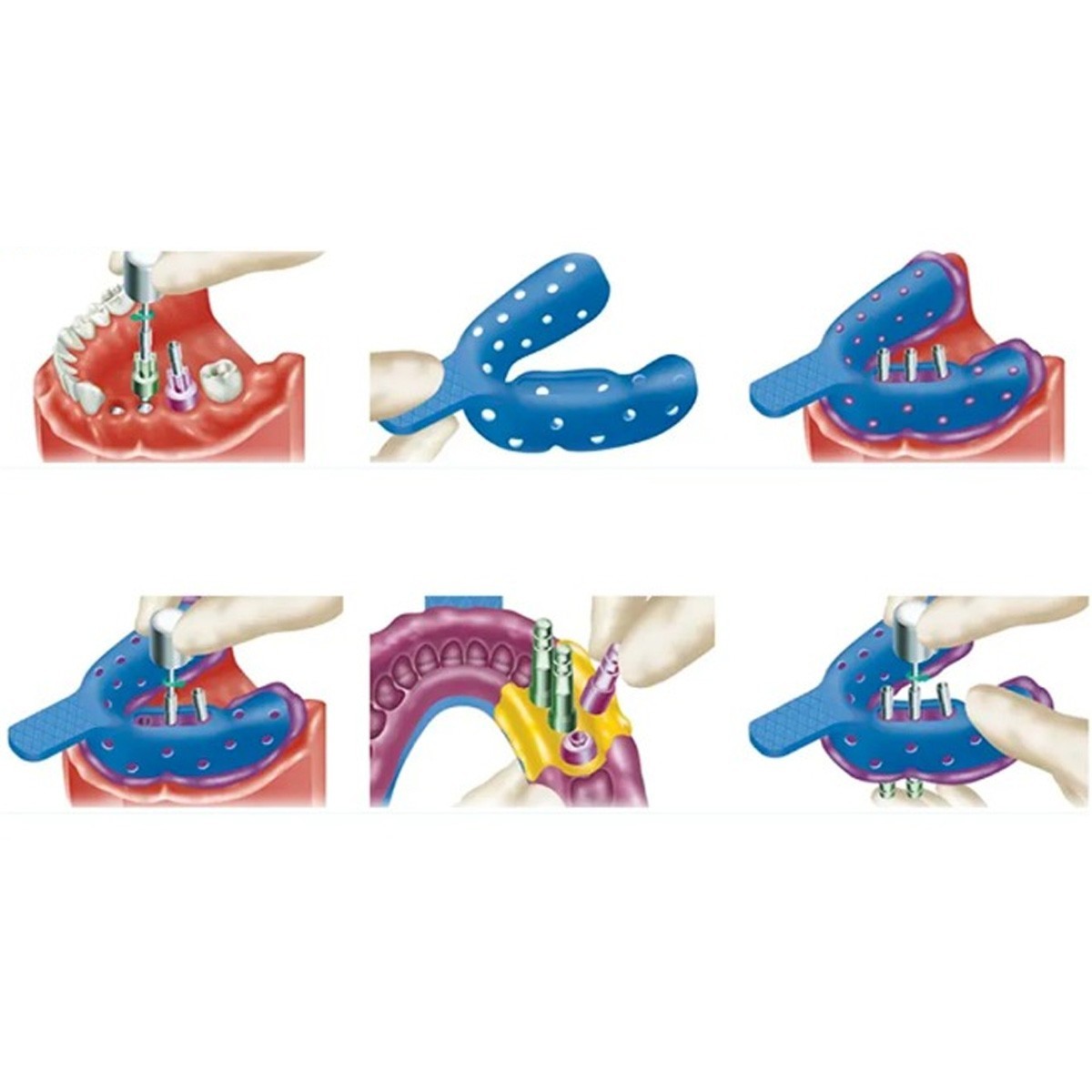US Nobel Dental Impression Coping Open Closed Tray & Lab Analog Fit NP RP Alloy
