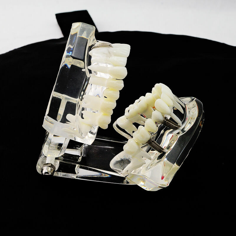 Dental Implant and Restoration Model Transparent Pathological Teeth Study Model