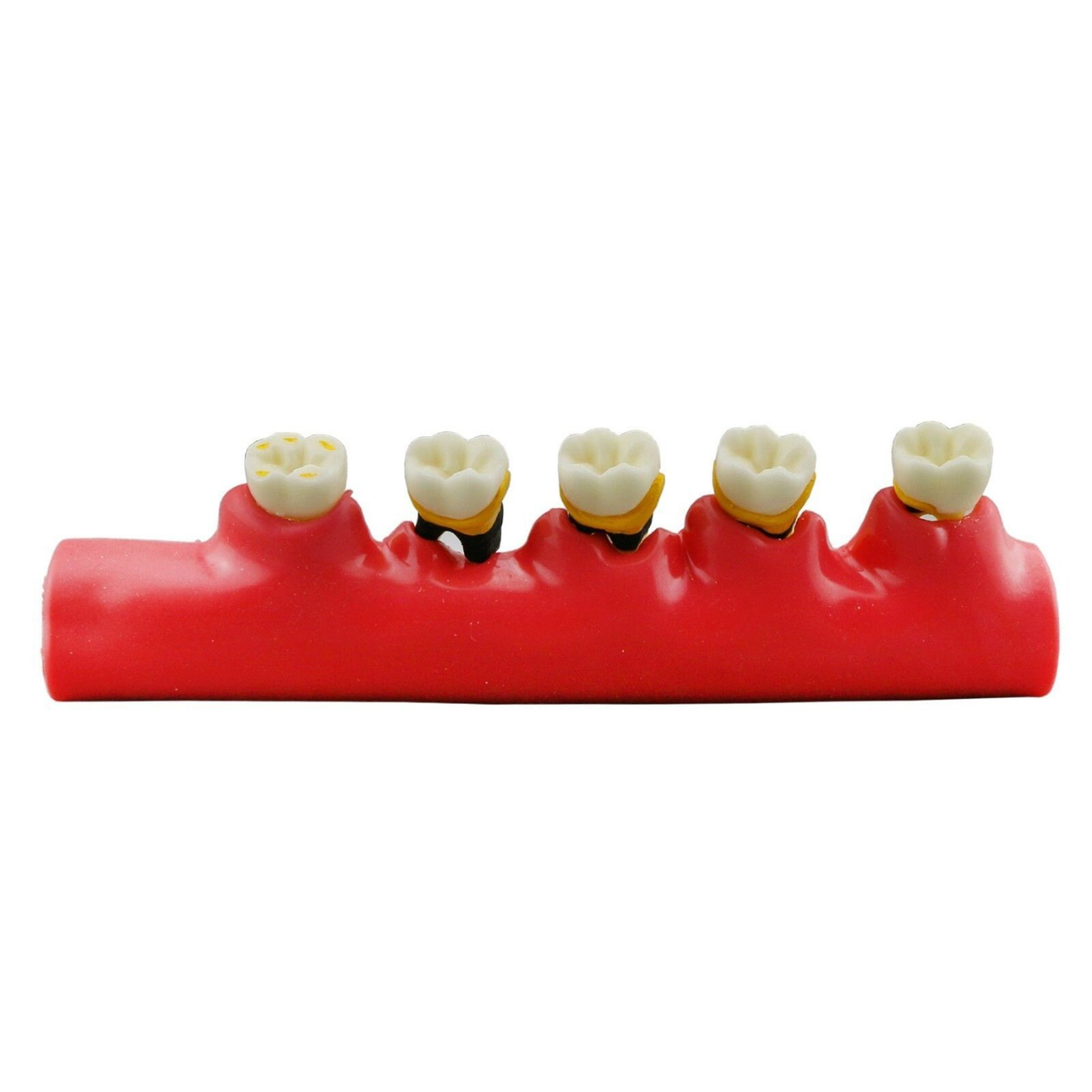 Dental Periodontics Disease 5-Stage Teeth Model Perio Disease Assort Demo Model