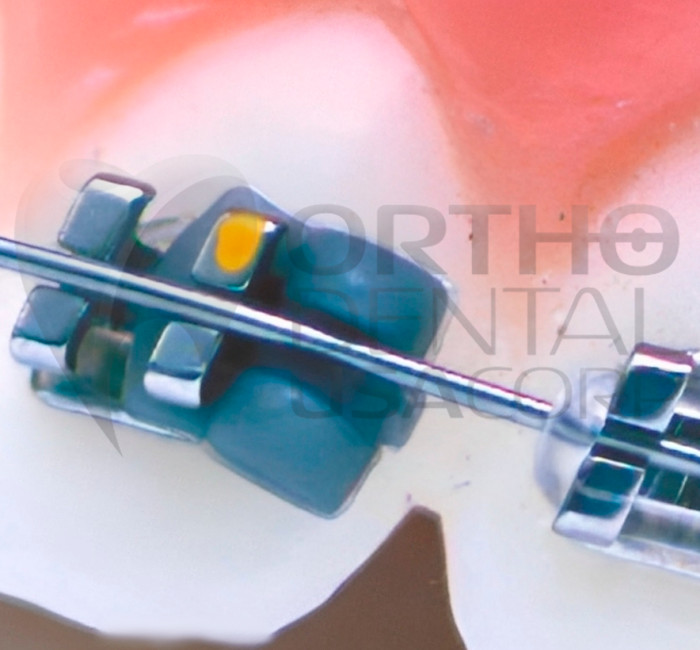Rotation wedges Elastic (100 PCS) Made of polyurethane Orthodontic USA Sellers