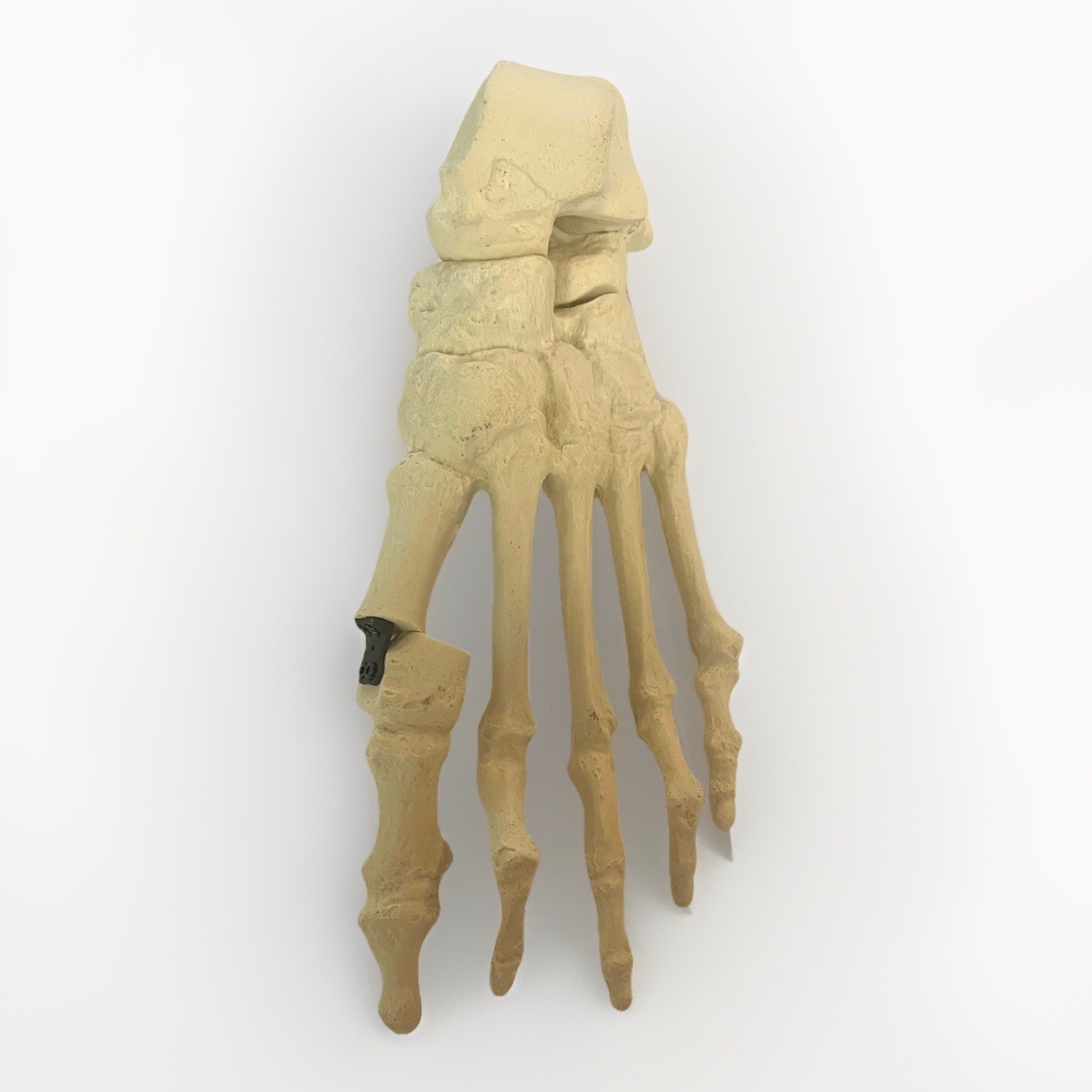Anatomic and Pathological Foot Skeletal Models Foot Surgery, Podiatry, Orthopods