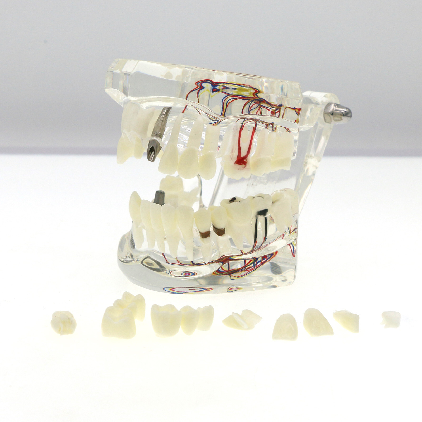 Dental Oral Typodont Model Implant Pathological Removable Teach Visible Anatomy