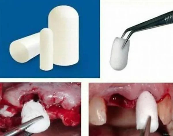 Cologenesis Colo Plug Sterile Collagen Sponge 8 X 20 mm PLUG0820 Free Shipping