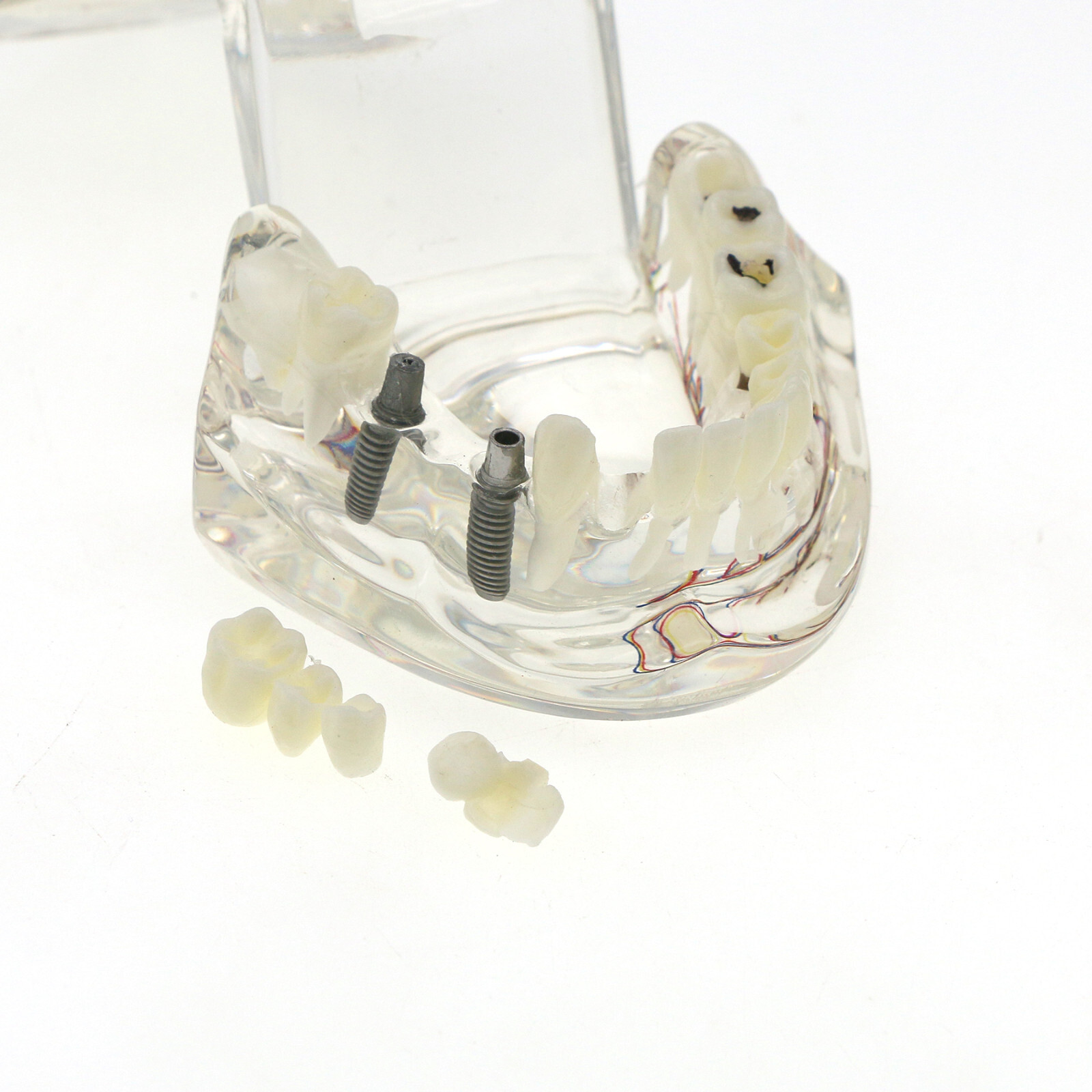 Dental Oral Typodont Model Implant Pathological Removable Teach Visible Anatomy