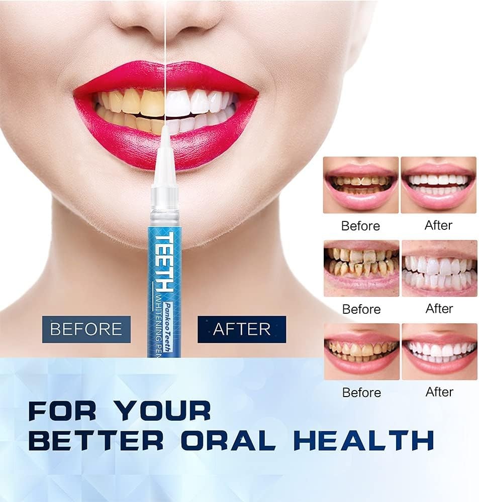 Teeth Whitening Pen 4+1(5 Pack), 70+ Treatments, 0.24 Fl Oz (Pack of 5), Bule