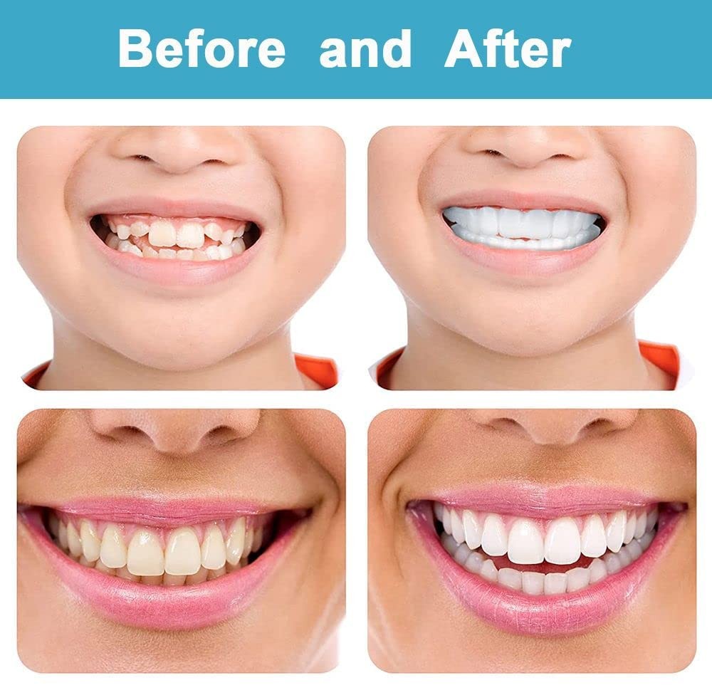 Top and Bottom Fake Teeth Cover the Broken Missing 1 Count (Pack of 1)