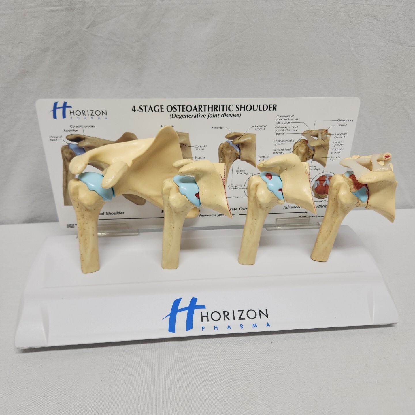 Degenerative Joint Disease 4 Stage Osteoarthritis Osteoarthritic Shoulder Model