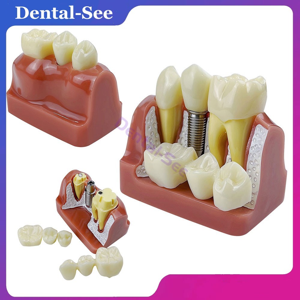 4 Times Dental Implant Analysis Crown Bridge Demonstration Study Teeth Model