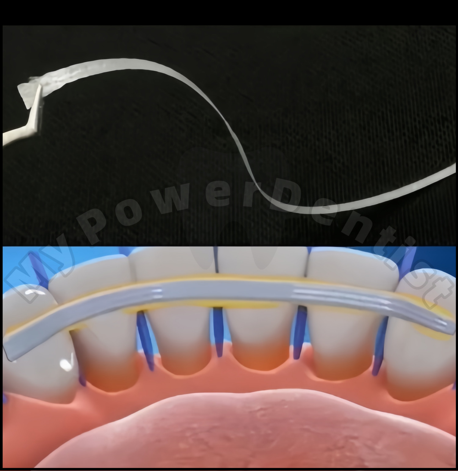 Dental Composite Flexible Fiber Strip Ribbond Ribbon Glass Fiber Bonding Strip