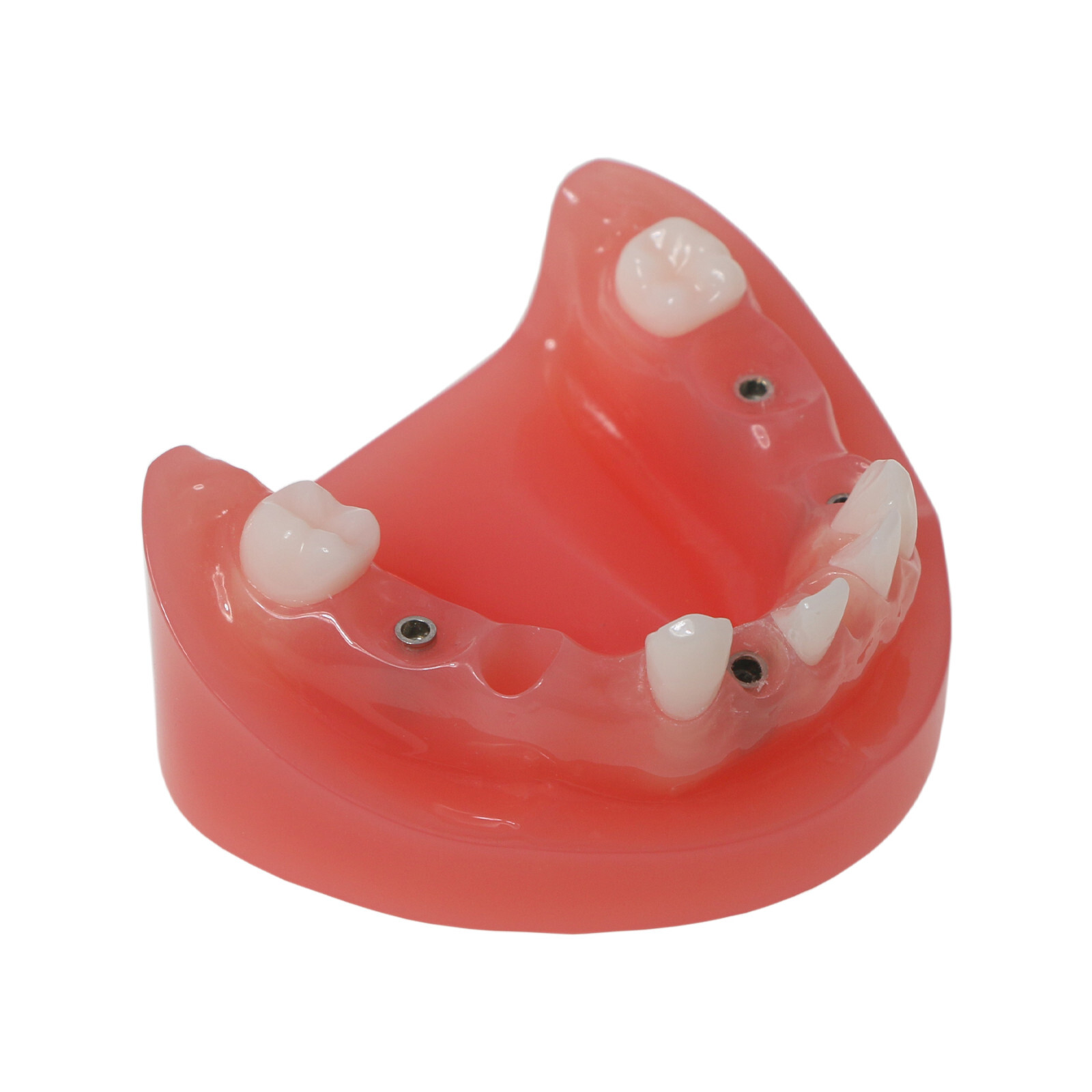Implant Typodont Teeth Restoration Model Overdenture Practice Demo Series Dental