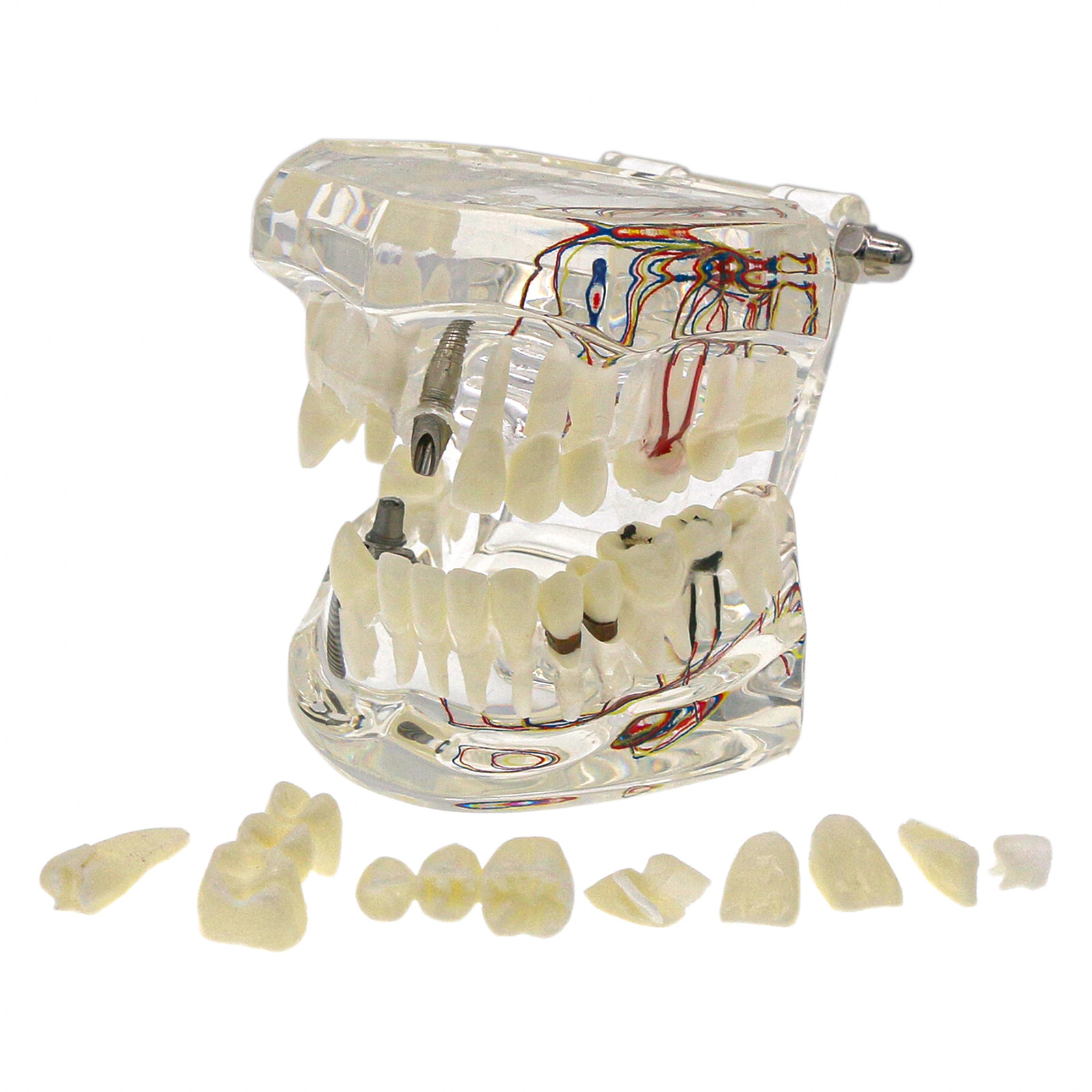 Dental Oral Typodont Model Implant Pathological Removable Teach Visible Anatomy