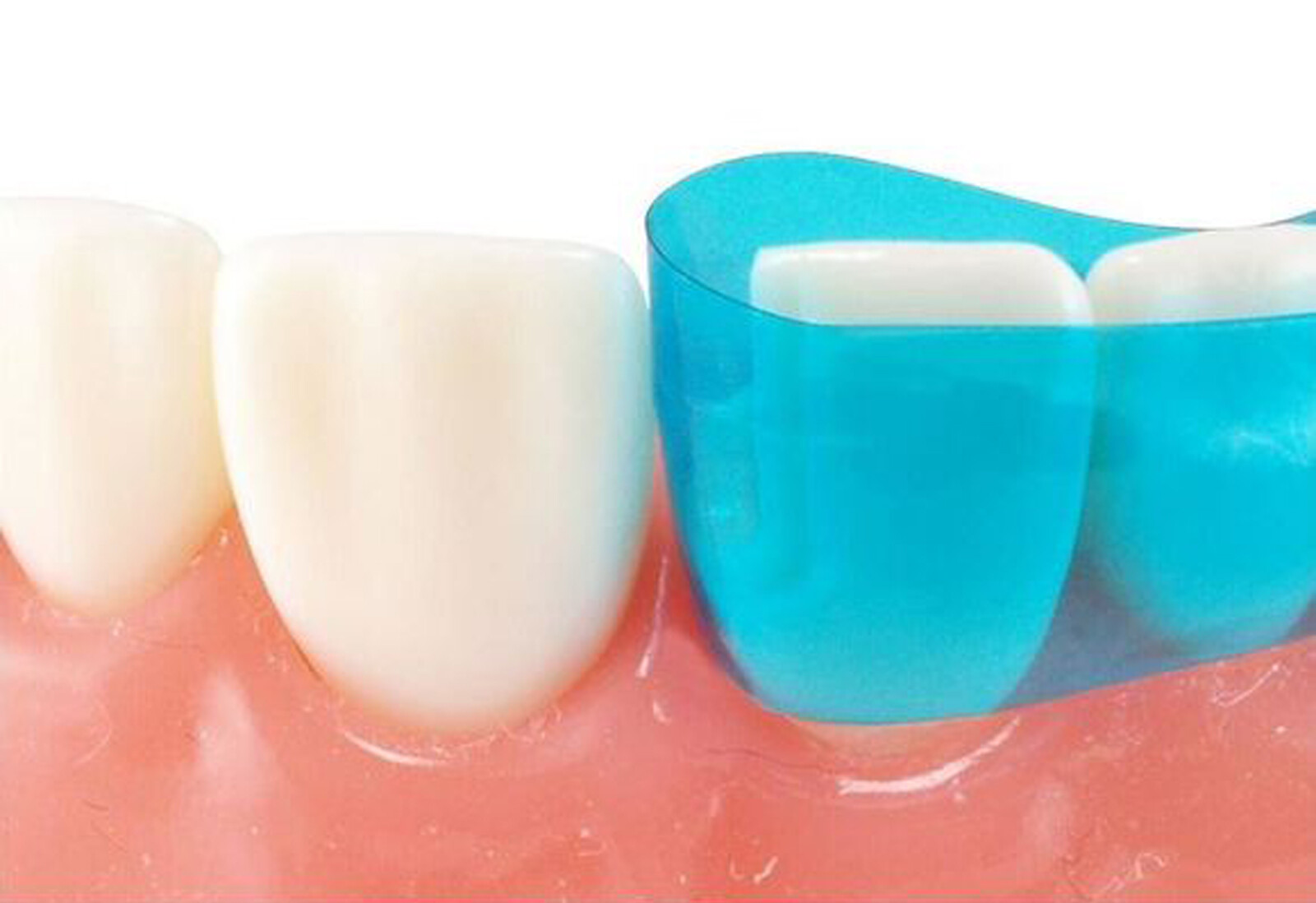 Dental Blue View Strip Anterior Restoration Strips Composite BT Clear Matrix