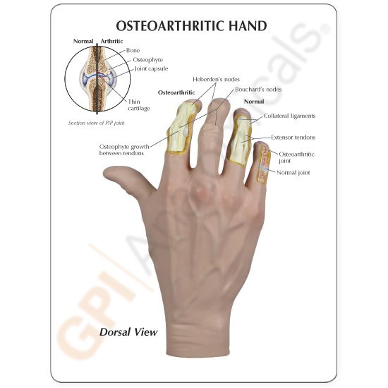 Hand Osteoarthritis (OA) GPI Anatomical Model LFA # 1930.Make Us An Offer! VIDEO
