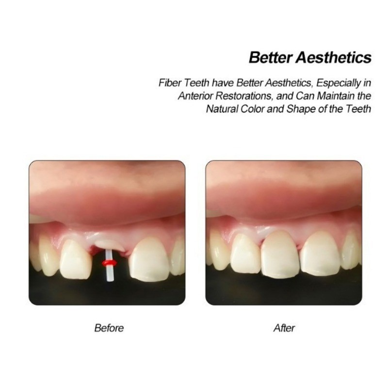 Dental Quartz Fiber Post Fiber Post teeth Restorative 1.2/1.4/1.6/1.8mm 200pcs