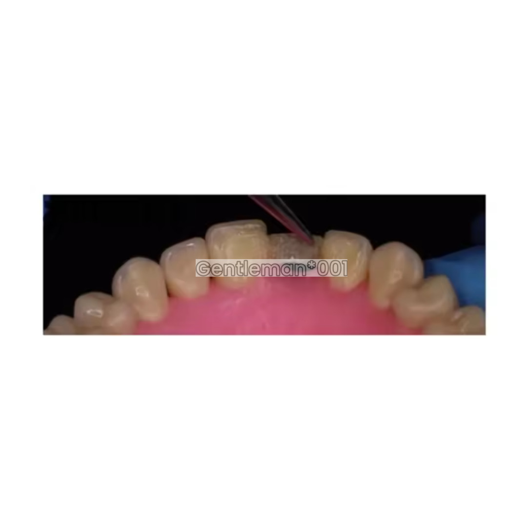 Dental Flexible Fiber Strip Band Retainer Glass Splint Loose Tooth Light Cure