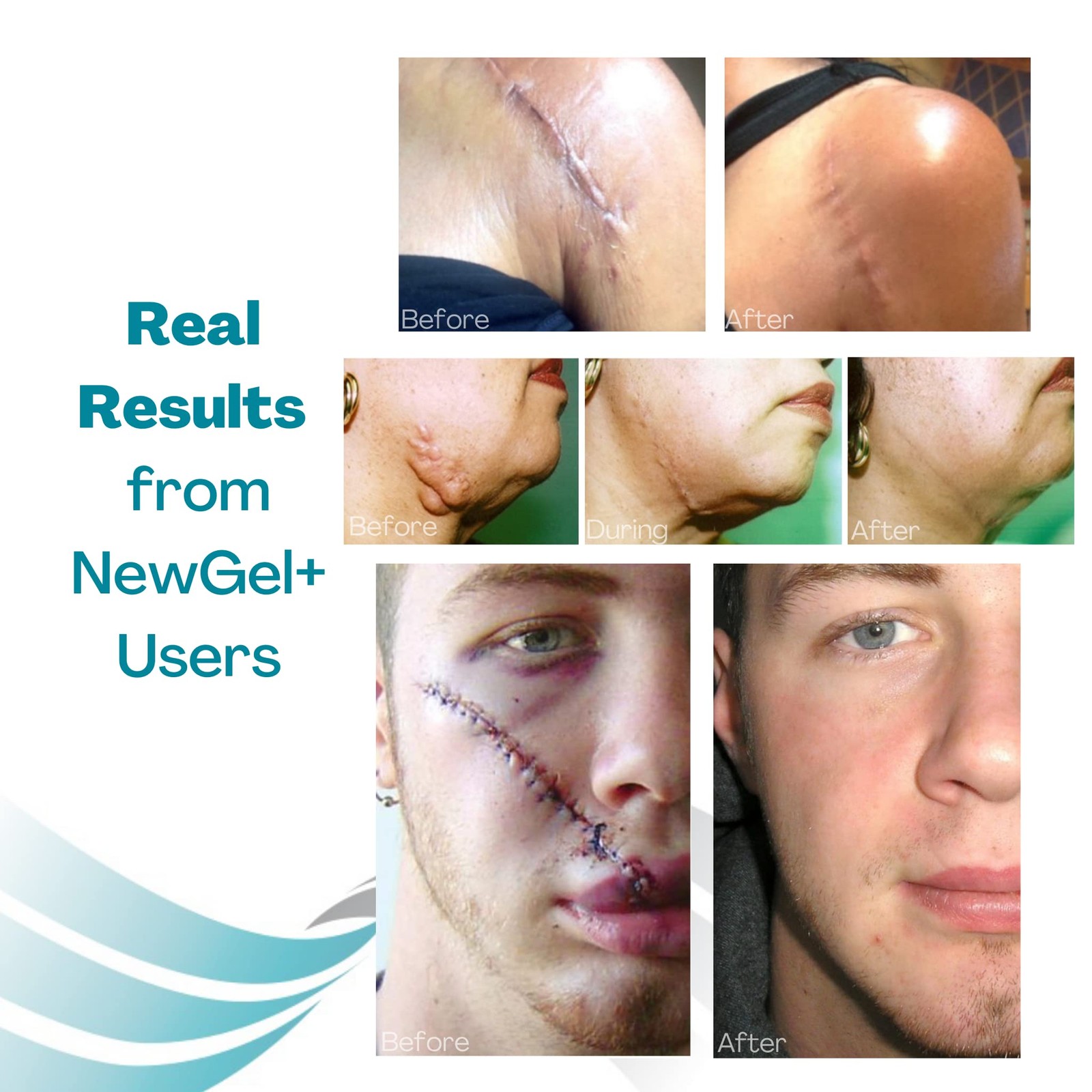 Newgel Advanced Silicone Professional Scar Sheets By Mynewgel Sheeting Set