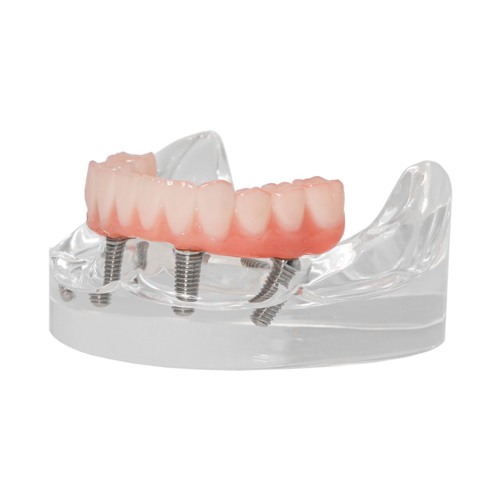 Dental Implant Overdenture Model Upper Lower Jaw Teeth Model with 2/4/6 Screws
