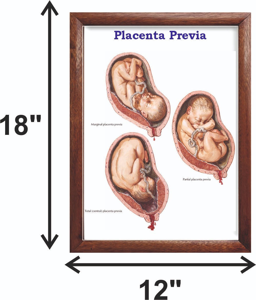 Placenta Previa Chart 12×18 inches