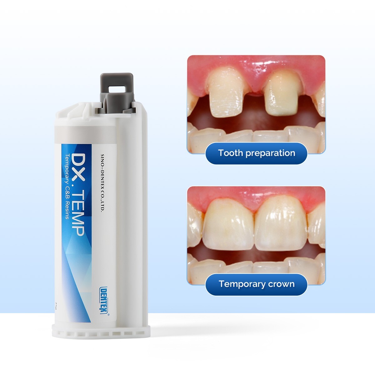 Dentex Dental Temporary Crown And Bridge Resin Material Cartridge 76g Shade A2