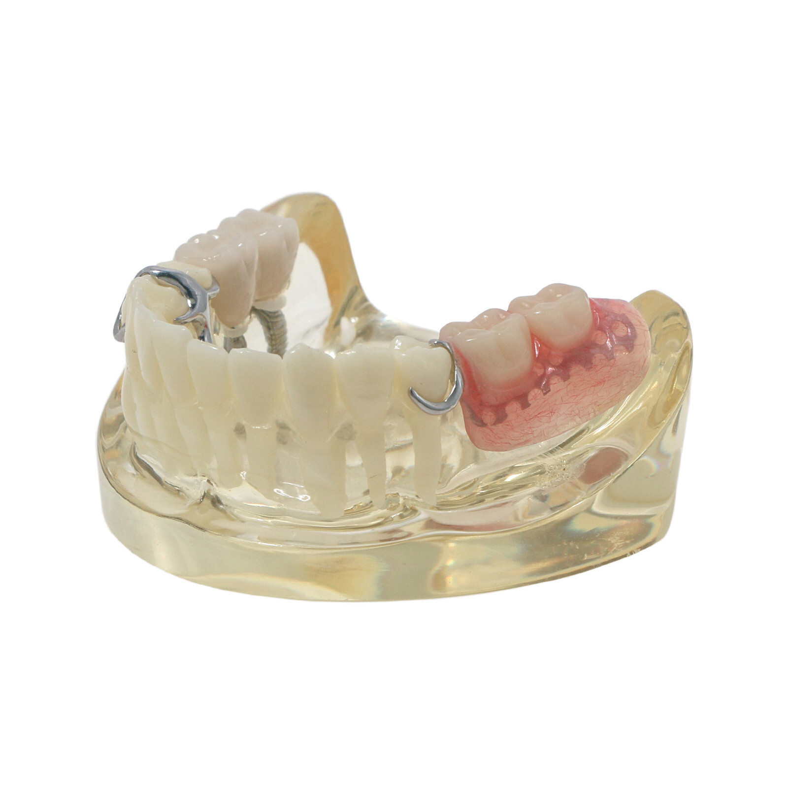 Dental Restoration Implant Typodont Teeth Model with Partial Denture M6022