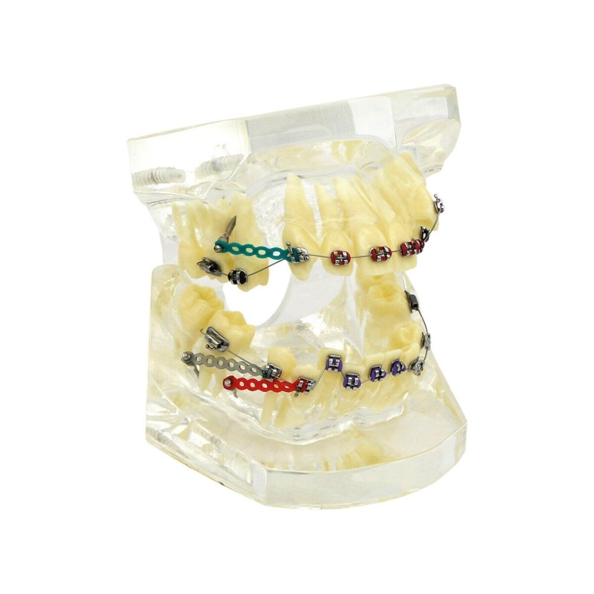 Dental Typodont Teeth Model Orthodontic Treatment Metal Ceramic BracketsRetainer