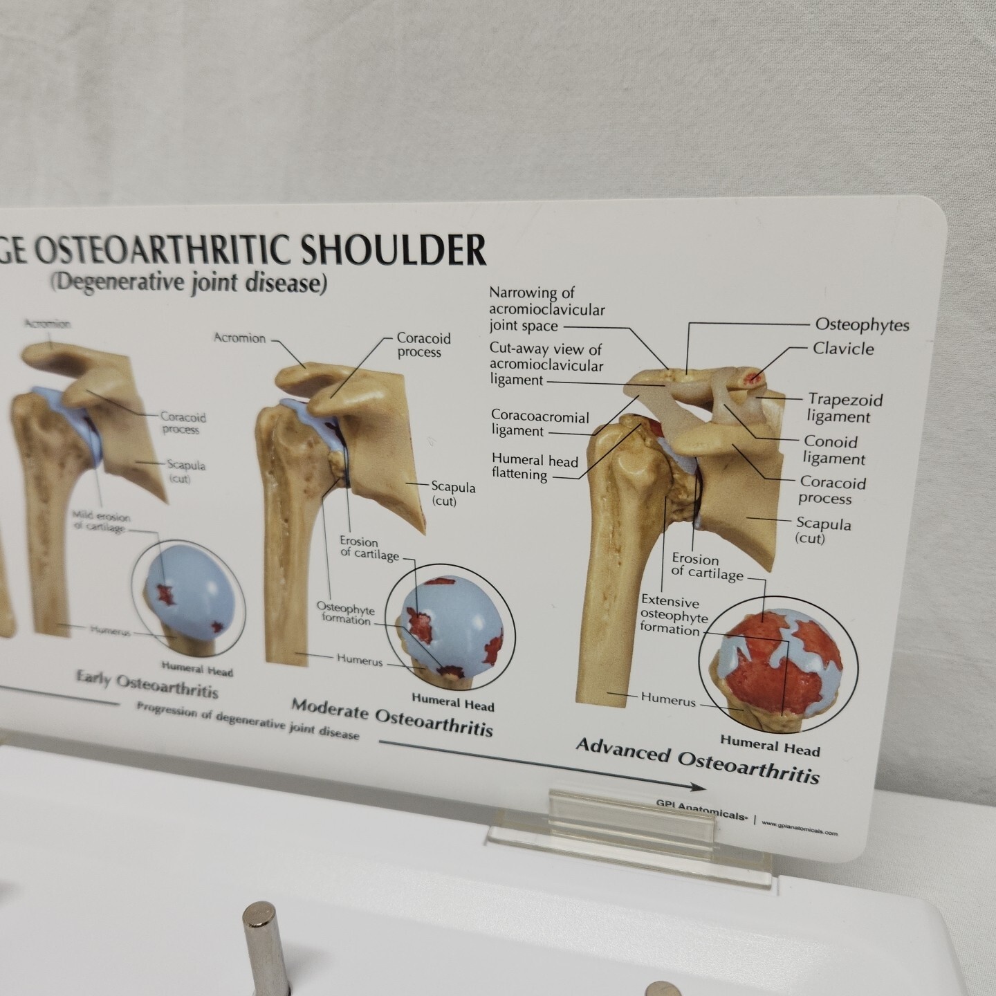 Degenerative Joint Disease 4 Stage Osteoarthritis Osteoarthritic Shoulder Model
