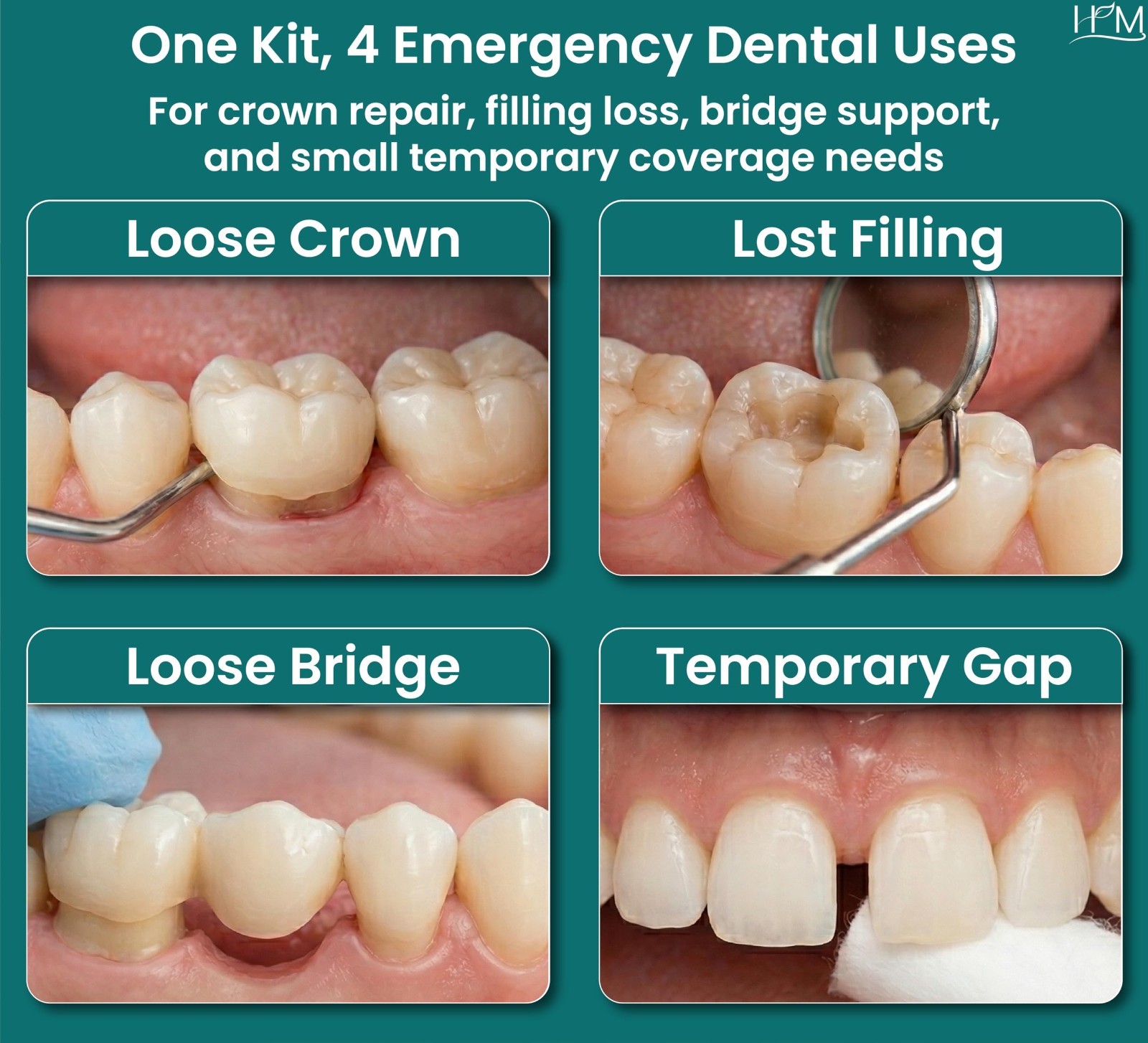 Zinc Oxide Eugenol Dental Cement Kit | Instant Tooth Repair & Filling | DIY Emer
