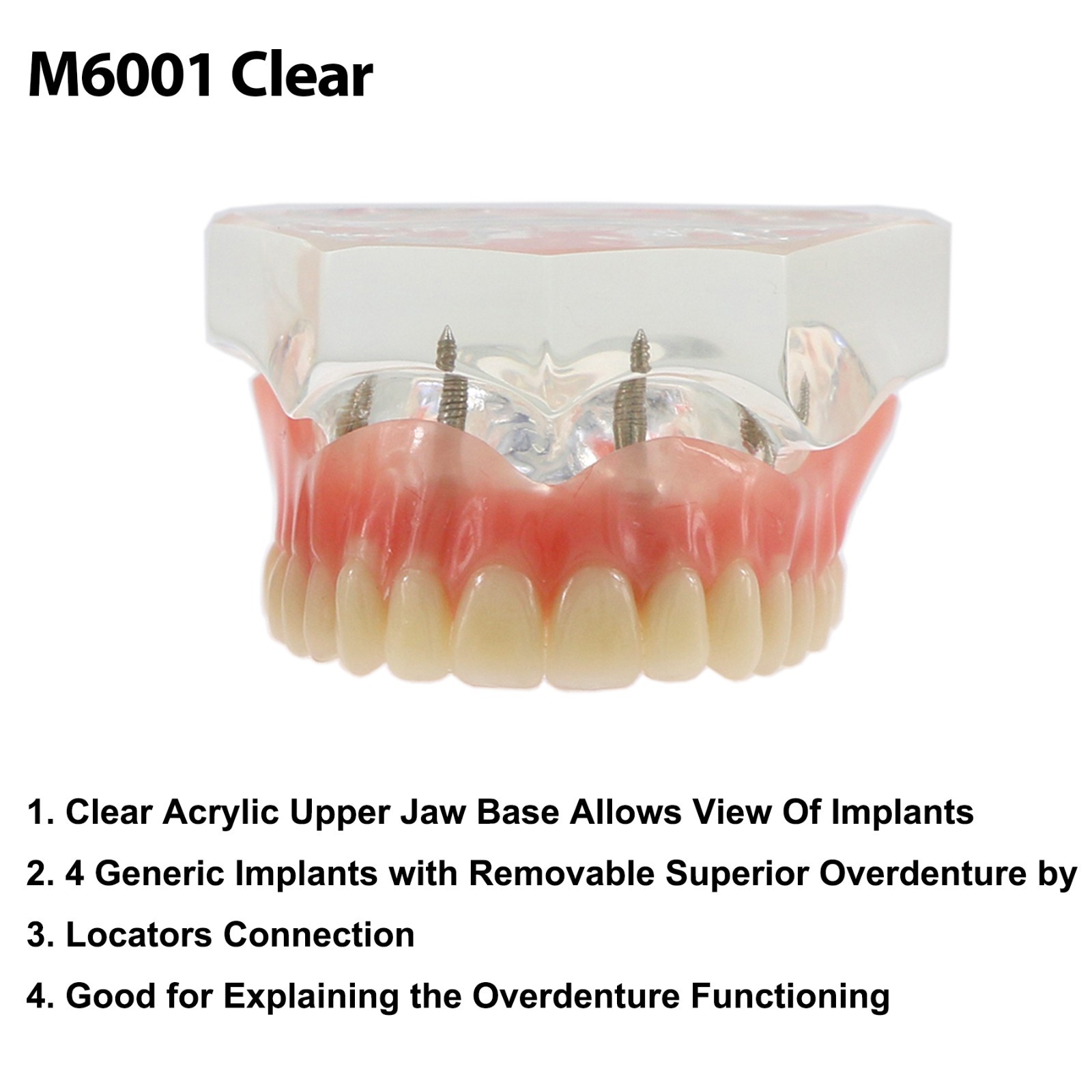 Dental Implant Overdenture Model Upper Lower Jaw Teeth Model with 2/4/6 Screws